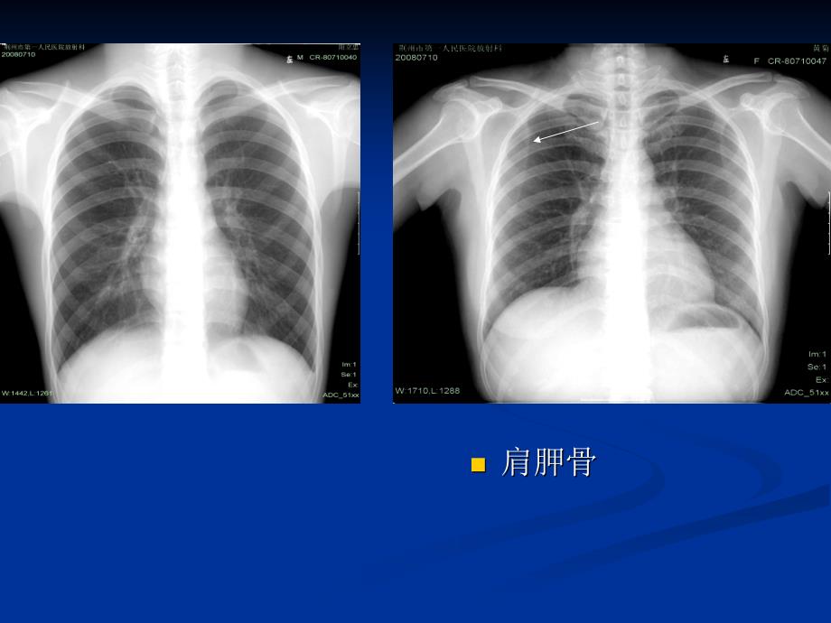 肺不张和肺实变_第3页