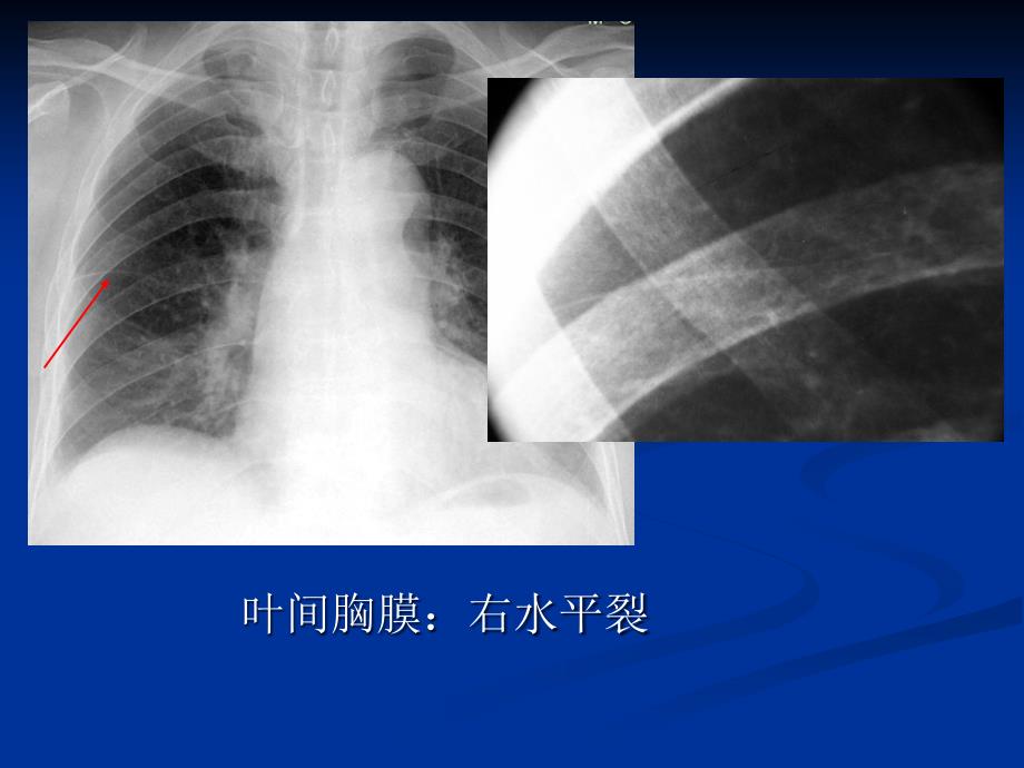 肺不张和肺实变_第4页