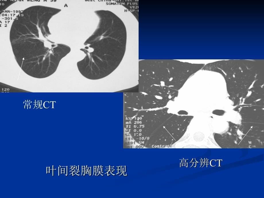 肺不张和肺实变_第5页