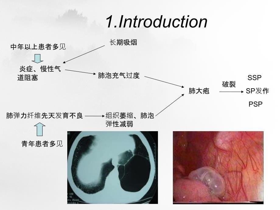 自发性气胸的临床治疗指南版解读_第5页