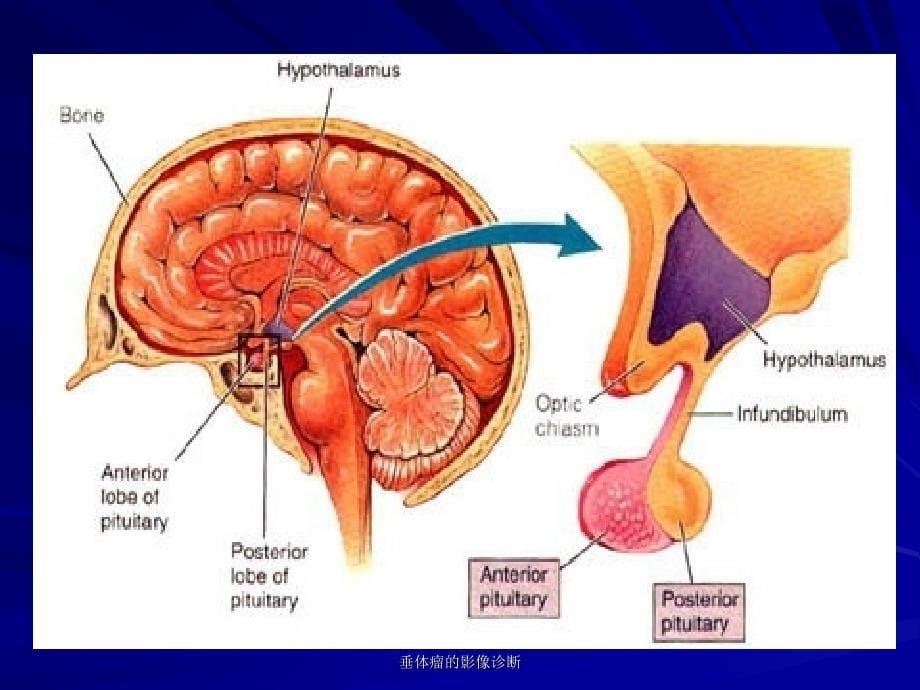 垂体瘤的影像诊断课件_第5页