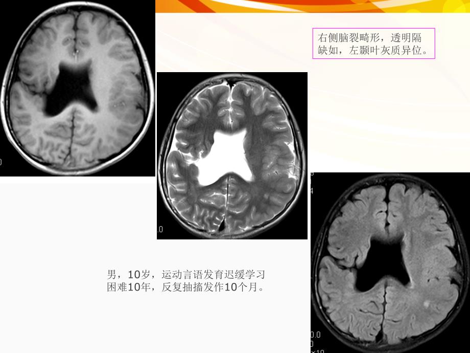 医学影像癫痫的MRIRS_第3页