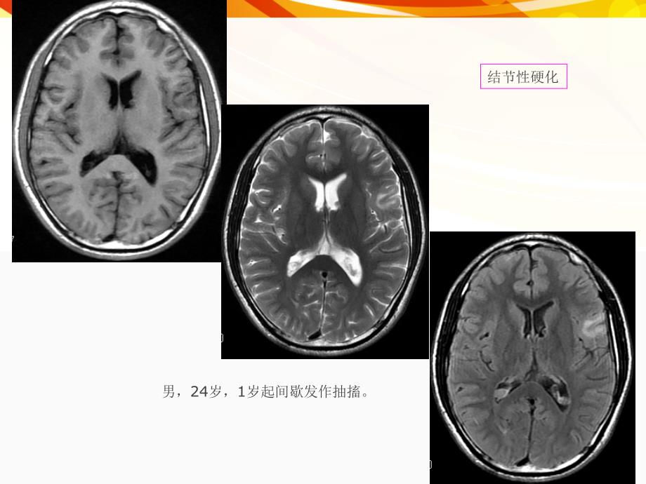 医学影像癫痫的MRIRS_第4页