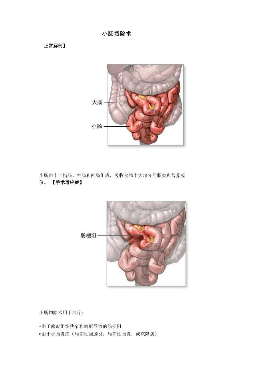 小肠切除术_第1页