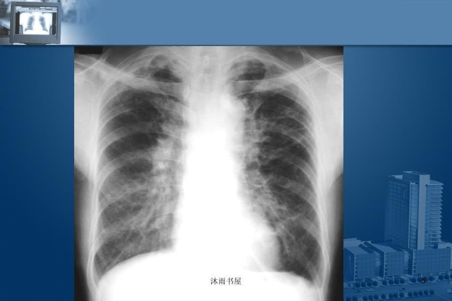 医学影像诊断PPT课件图文详解完整版-呼吸系统影像学[智囊书屋]_第5页