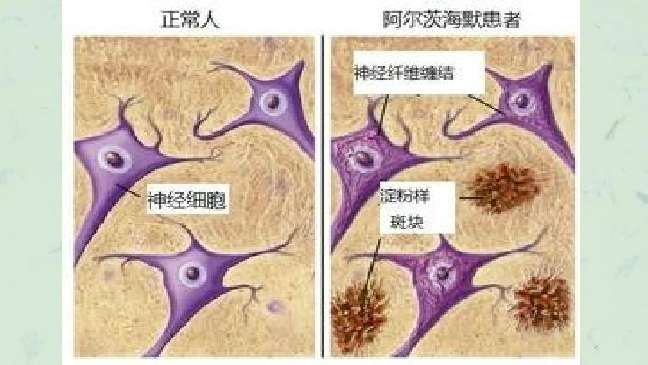 老年痴呆患者的健康教育课件_第4页