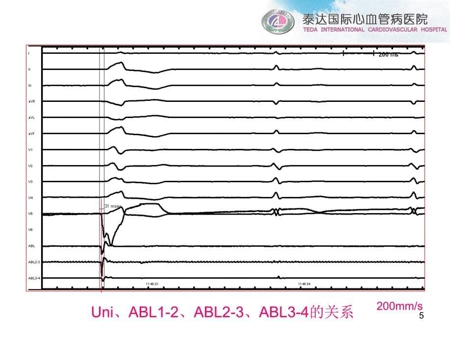 流出道室早消融体表心电图提供的决策_第5页