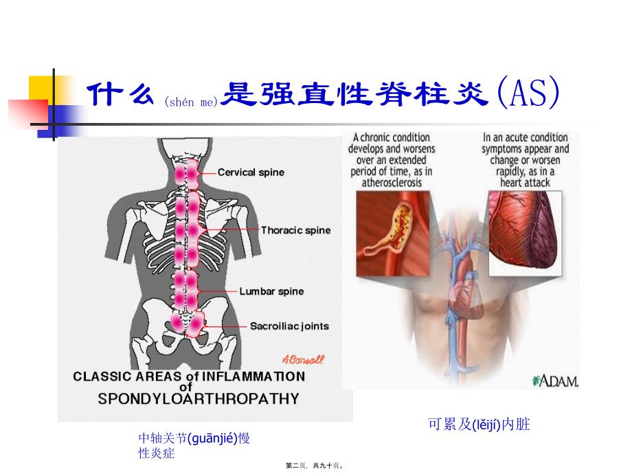 医学专题—强直性脊柱炎驼背21189_第2页