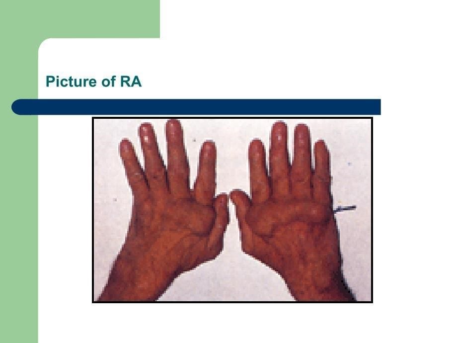 初诊患类风湿性关节炎1余_第5页