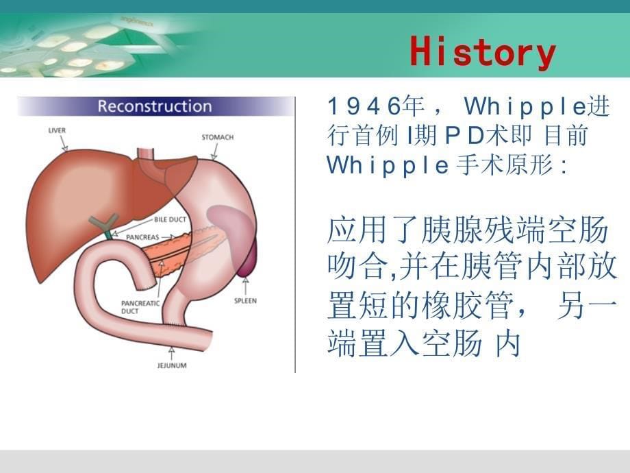 《胰肠吻合方式》PPT课件_第5页