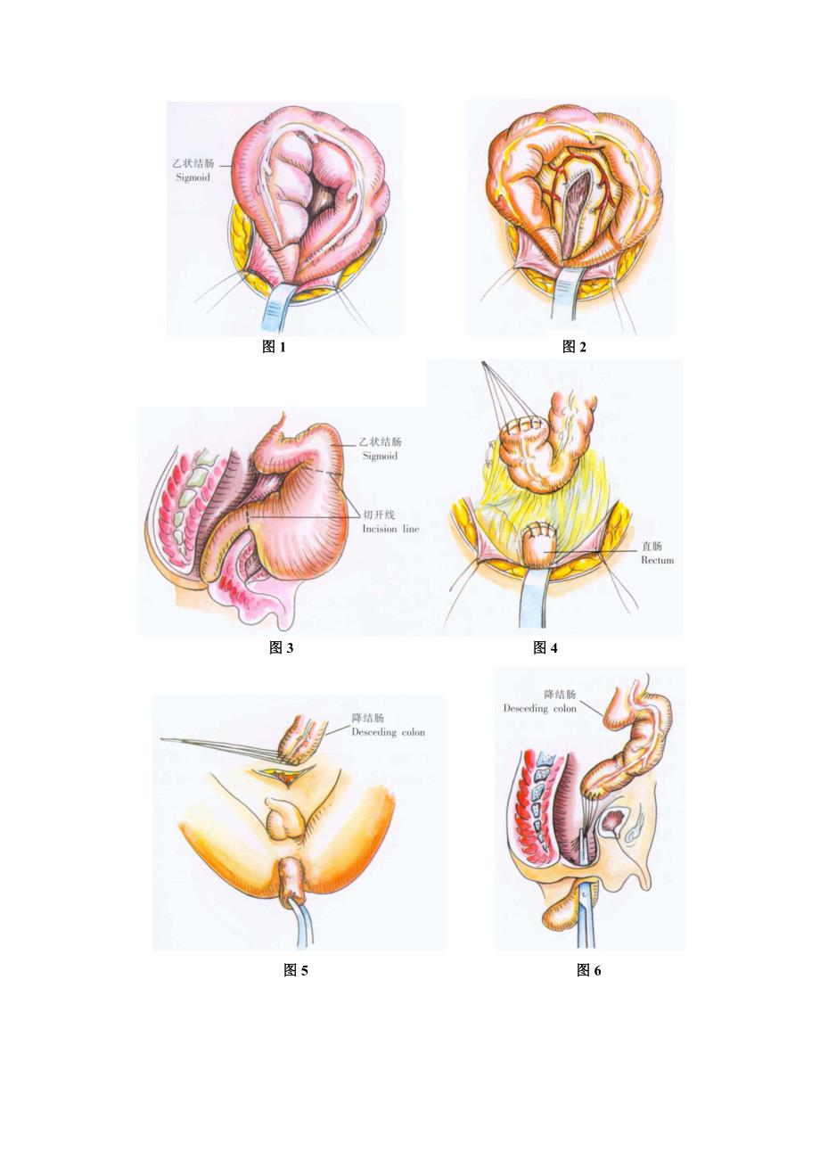 Swenson结直肠拉出切除术.doc_第2页