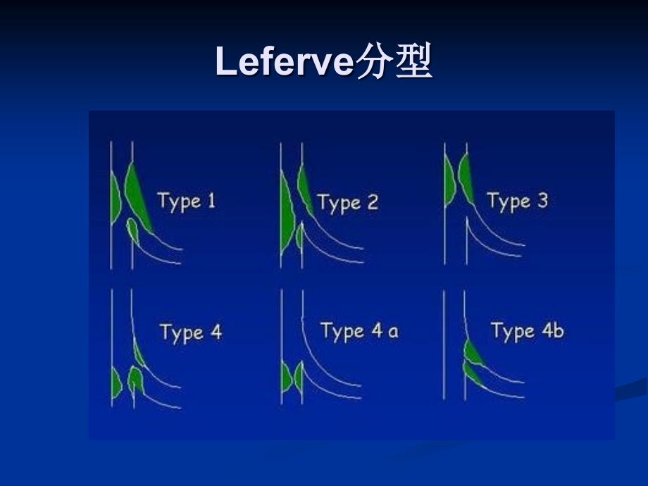 最新：冠脉分叉病变术式文档资料_第4页