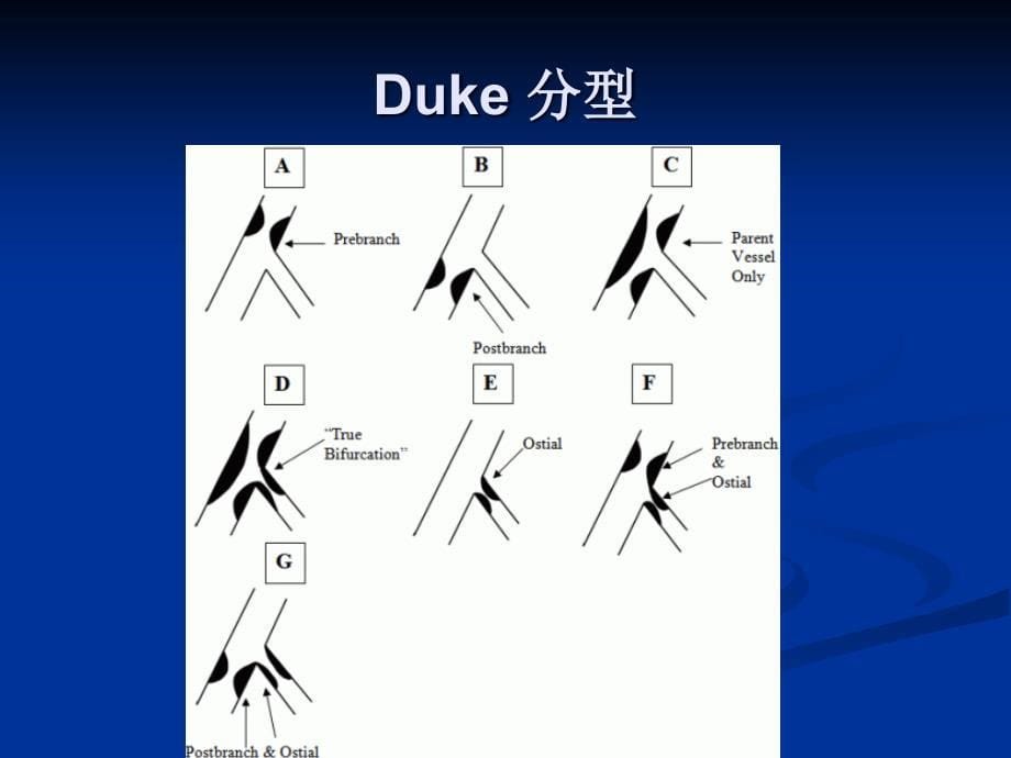 最新：冠脉分叉病变术式文档资料_第5页