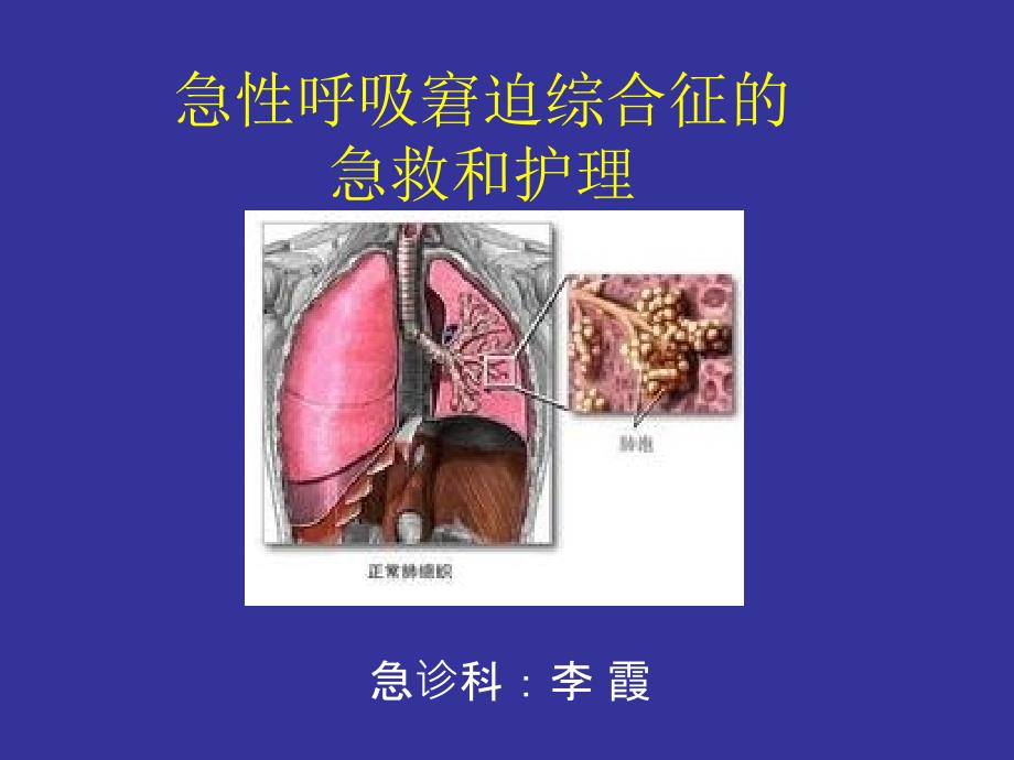 急性呼吸窘迫综合征的急救和护理_第1页