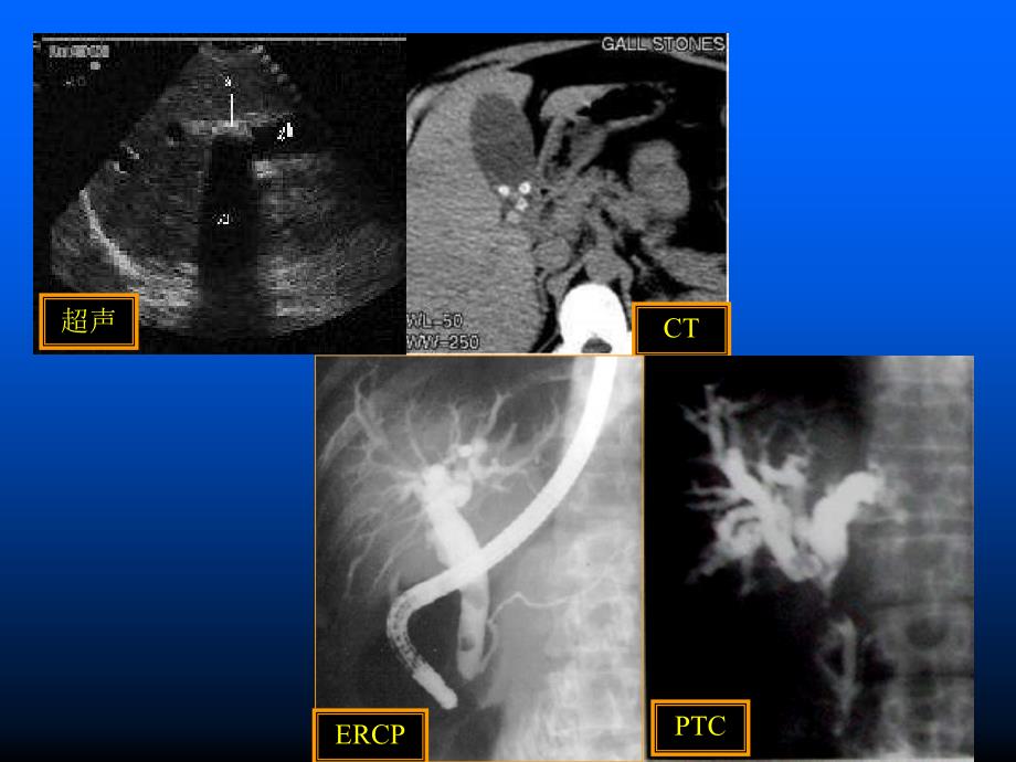 胆胰管疾病MRCP临床应用价值课件_第3页