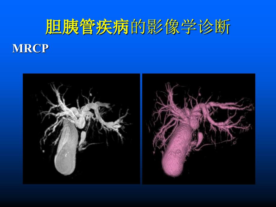 胆胰管疾病MRCP临床应用价值课件_第4页