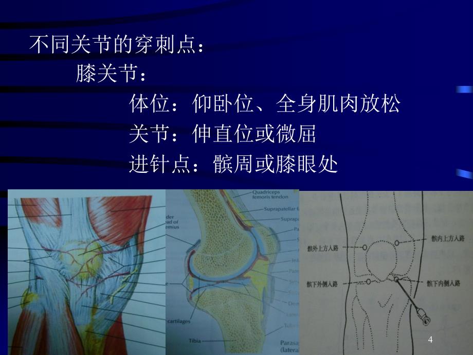 最新关节穿刺术ppt课件_第4页