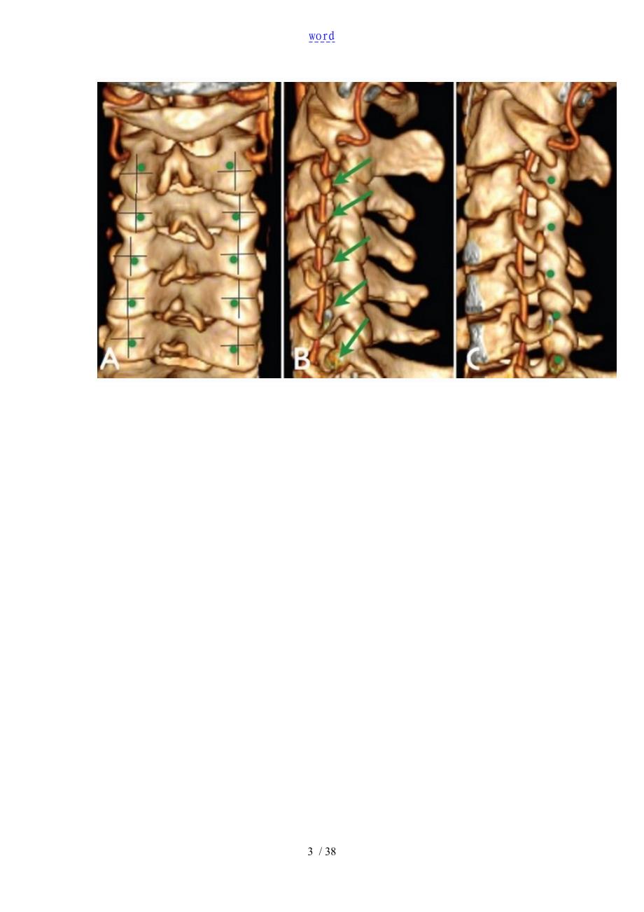 脊椎椎弓根钉进钉点地确定及手术技巧_第3页