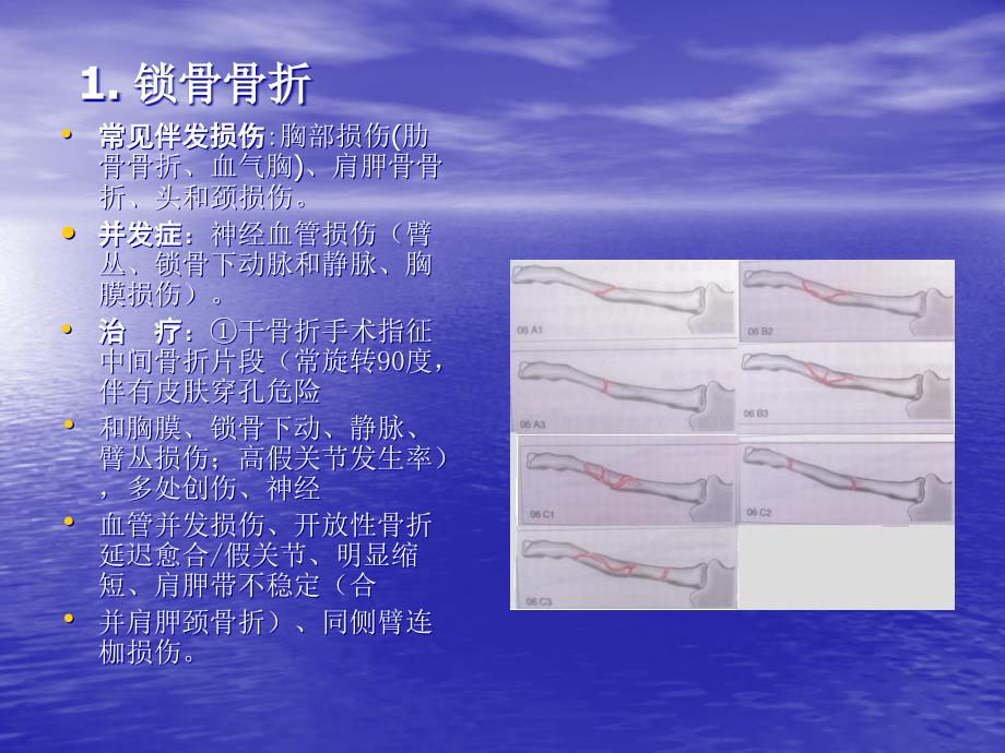 肩关节区域骨折与脱位诊断分型及治疗.ppt_第3页