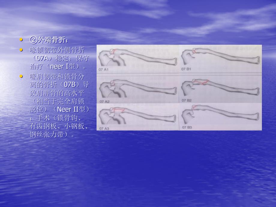 肩关节区域骨折与脱位诊断分型及治疗.ppt_第4页