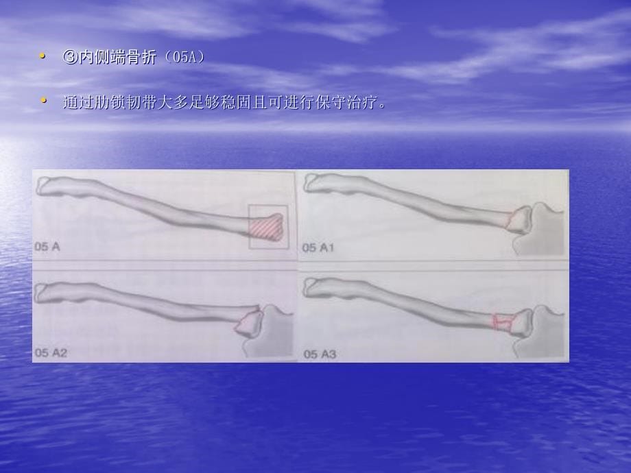 肩关节区域骨折与脱位诊断分型及治疗.ppt_第5页