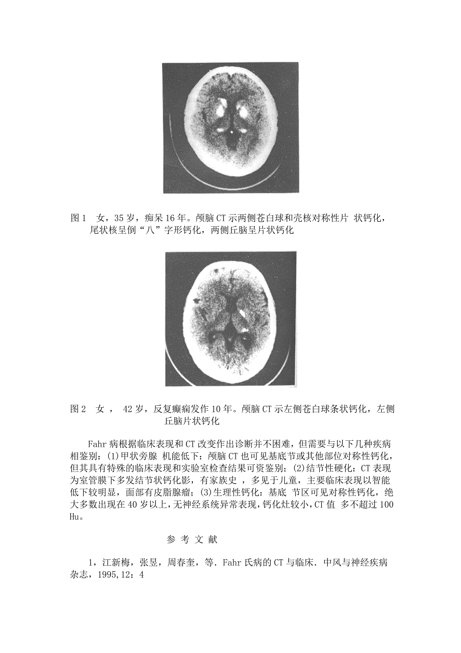 Fahr病的临床与CT_第3页