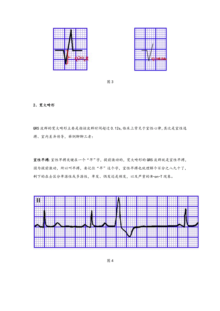 心电图QRS波群的五种_第4页