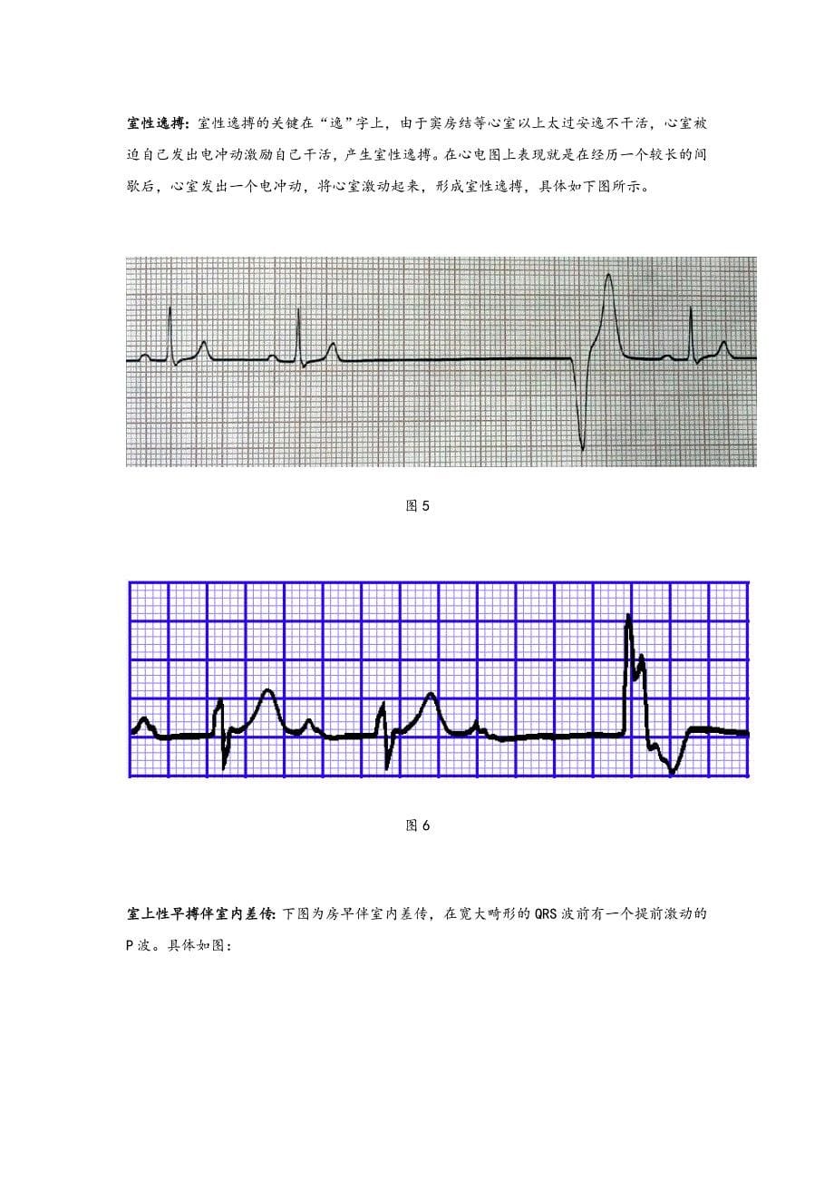 心电图QRS波群的五种_第5页