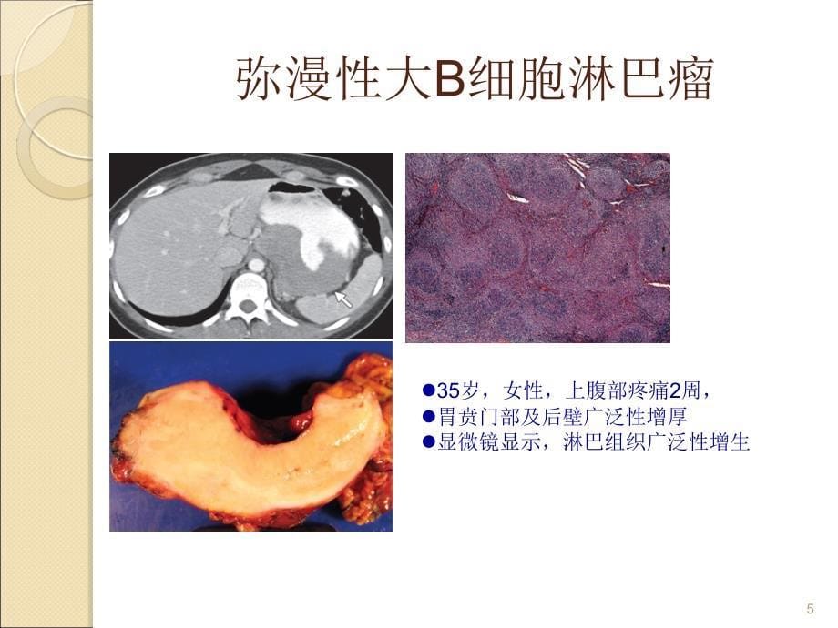 胃肠道淋巴瘤的影像学表现ppt课件_第5页