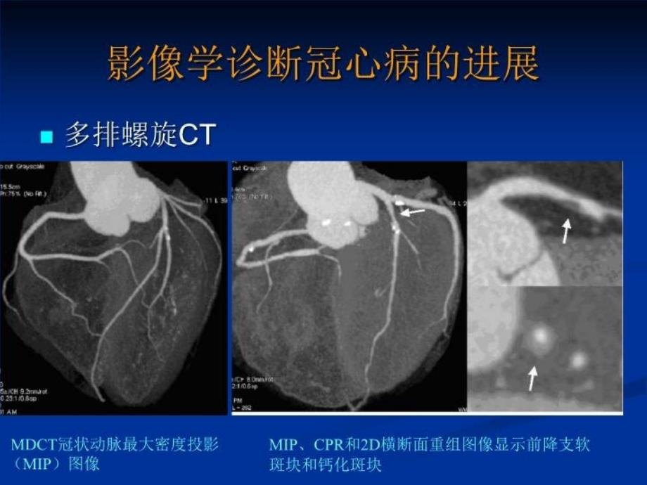 最新心电运动试验的进展PPT课件_第4页