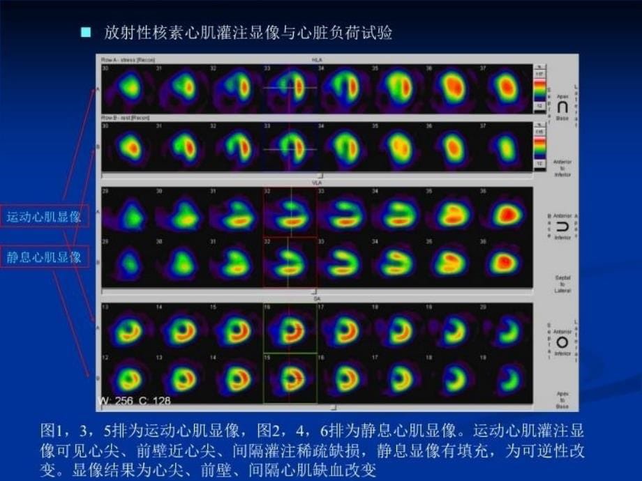 最新心电运动试验的进展PPT课件_第5页