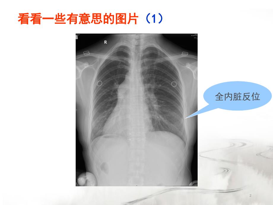 腮腺常见疾病的CT诊断ppt课件_第2页