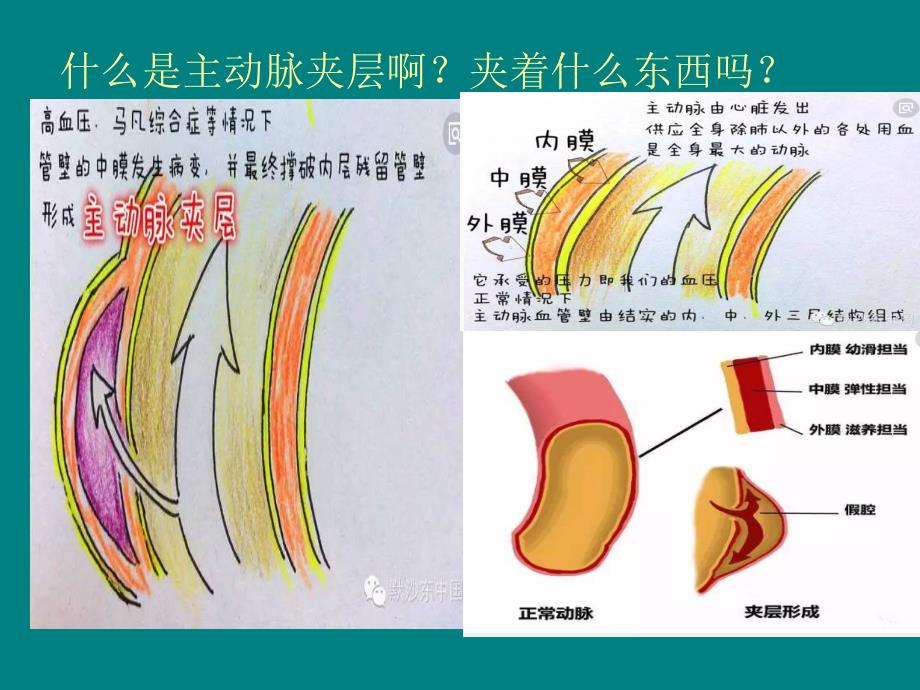 主动脉夹层的病例讨论_第3页