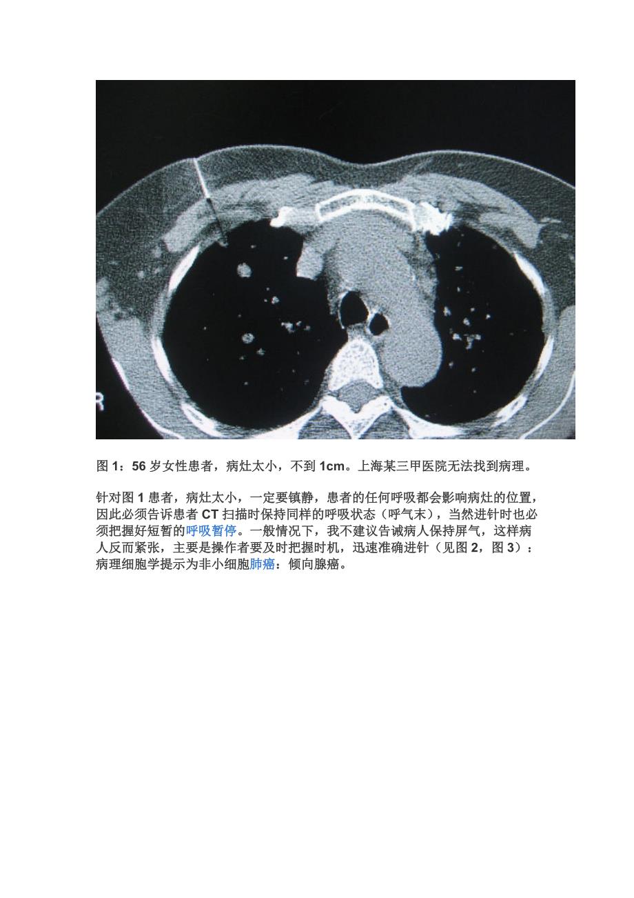 CT引导下经皮肺穿刺的几点心得_第3页