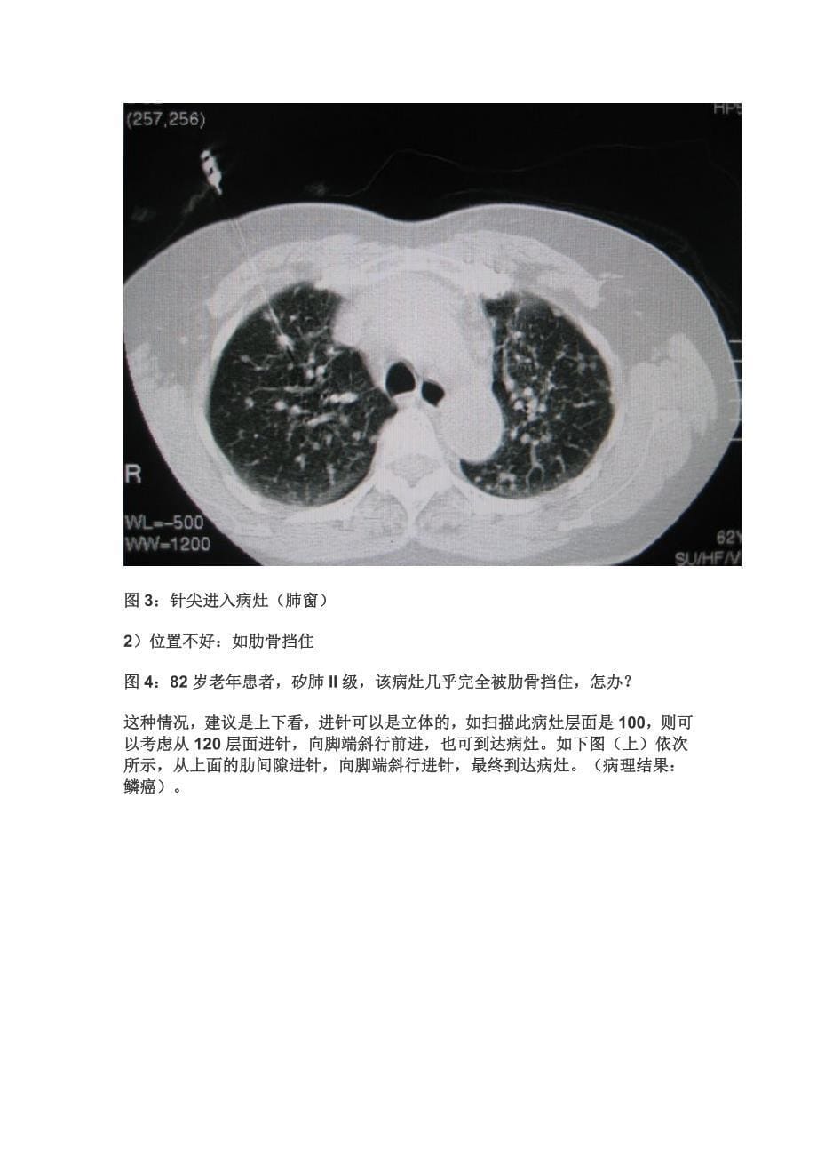 CT引导下经皮肺穿刺的几点心得_第5页