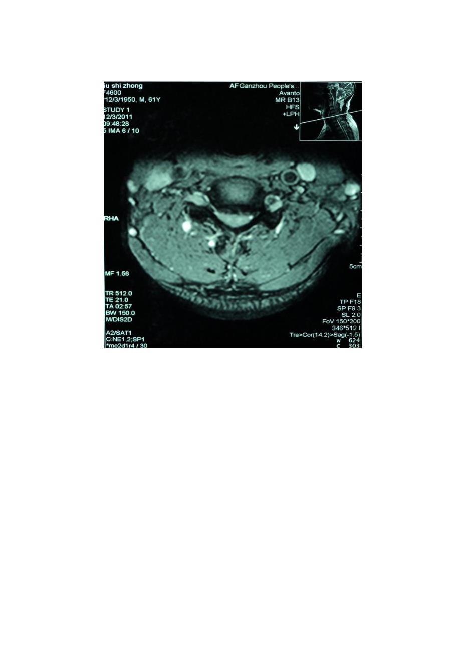 第13章-颈椎病康复-案例教学_第2页
