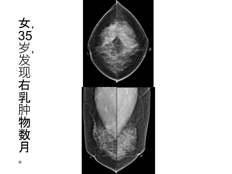 乳腺癌的x线诊断及鉴别诊断ppt课件_第2页