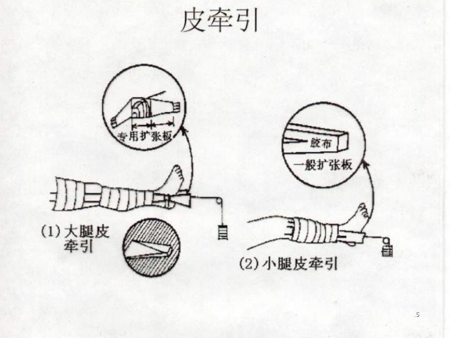 骨科牵引病人的护理要点课件_第5页