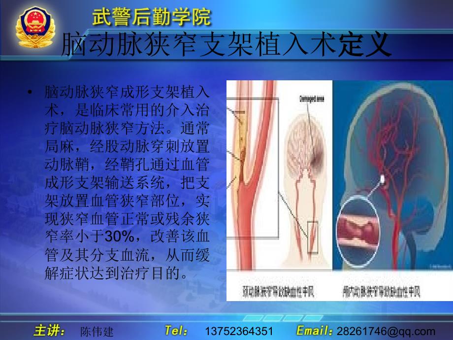 脑动脉狭窄支架植入术及护理_第3页