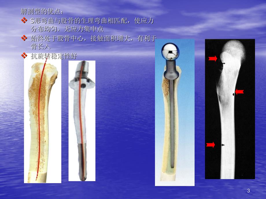 常用髋关节假体类精选PPT_第3页