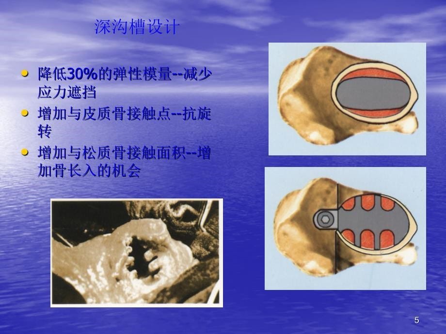 常用髋关节假体类精选PPT_第5页