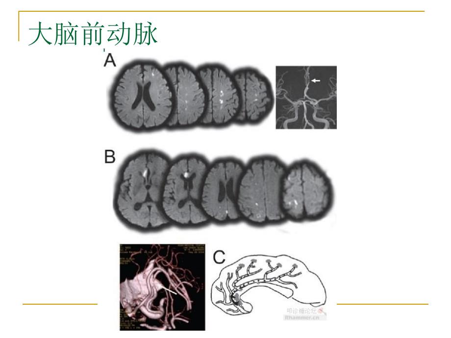 从影像梗死部位推测责任供血血管名师编辑PPT课件_第4页