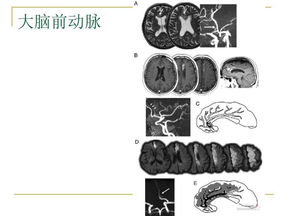 从影像梗死部位推测责任供血血管名师编辑PPT课件_第5页