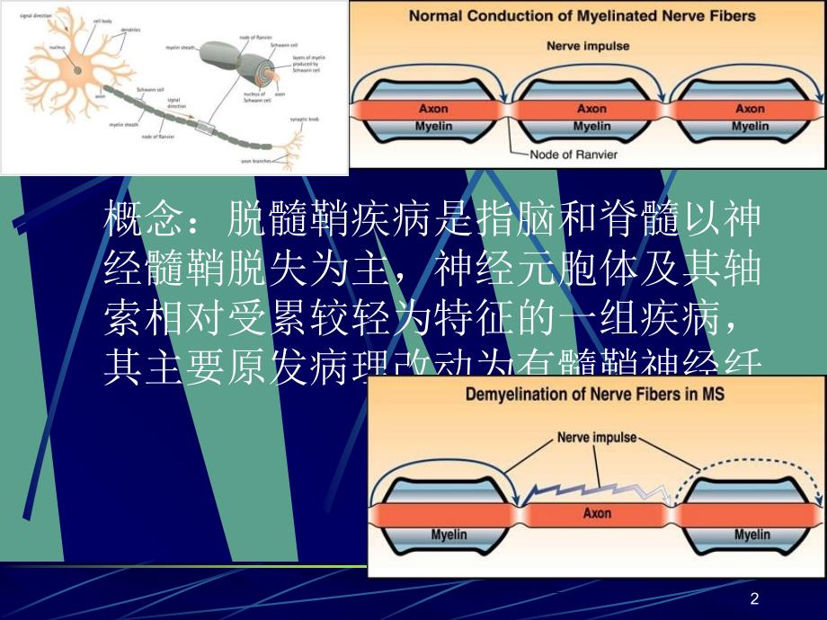 中枢神经系统脱髓鞘疾病本科ppt课件_第2页