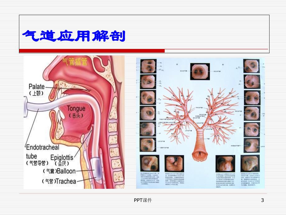 人工气道护理--课件_第3页