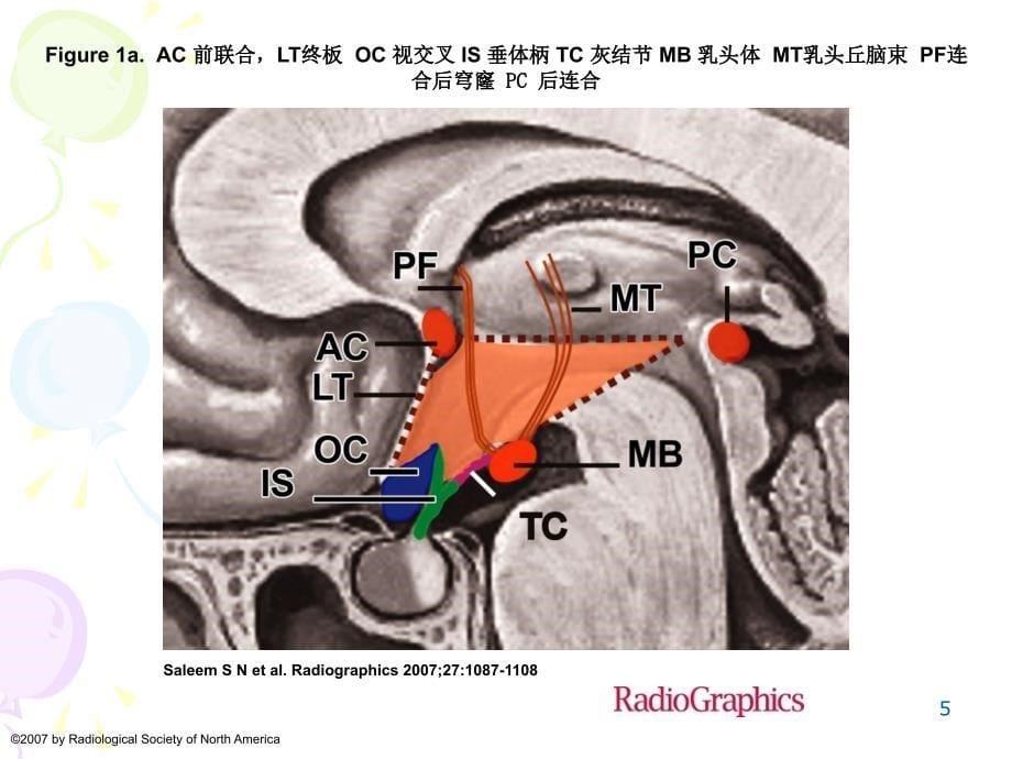 下丘脑病变的MR诊断_第5页