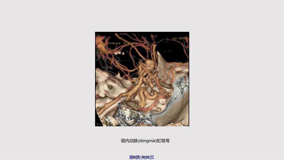 CTA头部血管成像中的临床应用实用教案_第3页