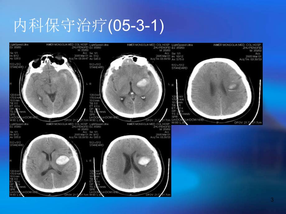 微创颅内血肿粉碎清除术在神经内科的应用_第3页