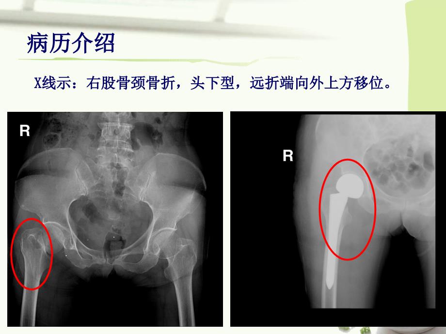 髋关节置换护理业务查房_第4页