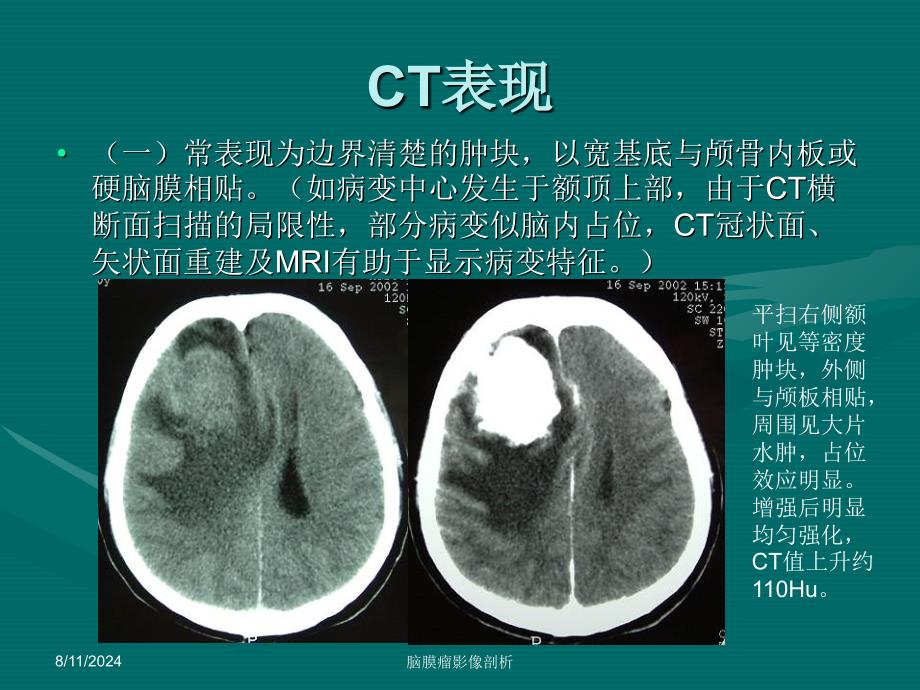 脑膜瘤CT、MRI表现_第3页